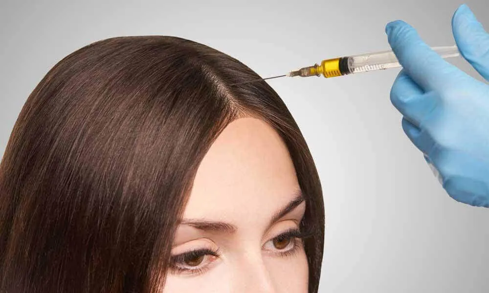 PRP Hair Treatment in Dubai and Hair Transplant in Dubai Stimulate Growth Naturally Effectively - Newsglo PRP Hair Treatment in Dubai and Hair Transplant in Dubai Stimulate Growth Naturally Effectively - Newsglo
