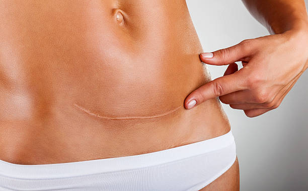 When Can Scar Removal Be Repeated Safely? - Newsglo