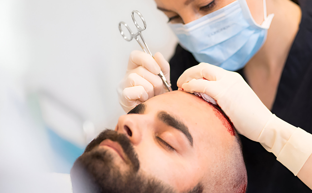 Hair Transplant in Islamabad