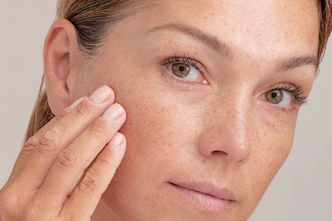 Melasma treatment in Islamabad Doctor Tips - Newsglo
