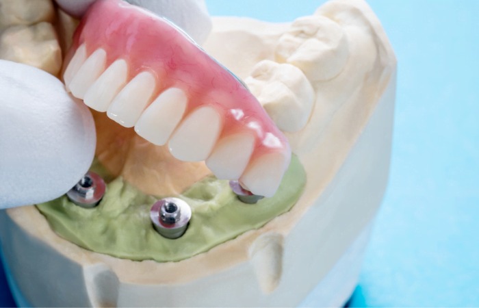 A Permanent Solution for Complete Tooth Loss
