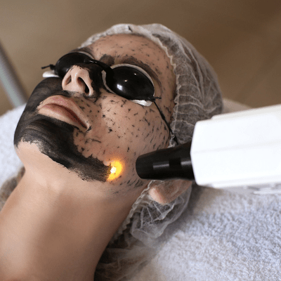 Is Spectra Carbon Peel Good for Sensitive Skin?