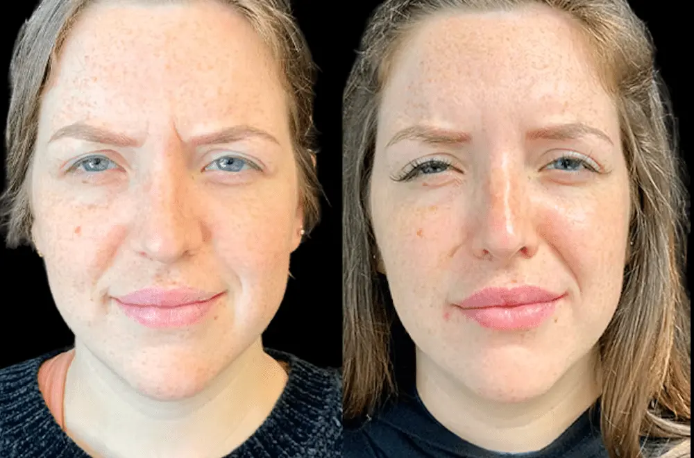 Botox in Dubai: Is It Safe? Regulations and Medical Standards