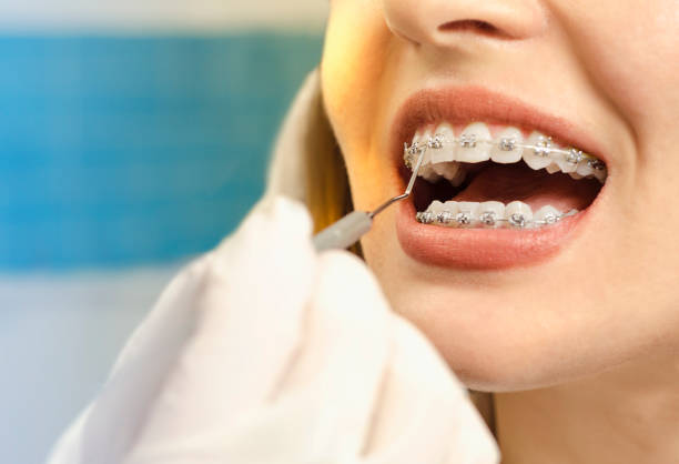 The Role of Braces in Achieving Long-Term Dental Health in Arcadia - Newsglo