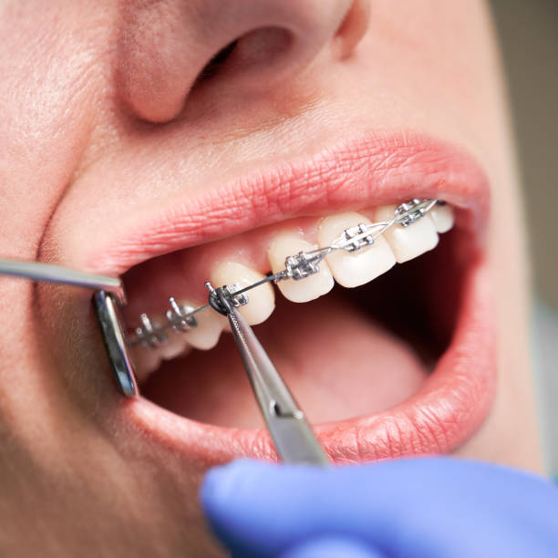 A Practical Look at Modern Orthodontic Care with Cupertino Braces - Newsglo