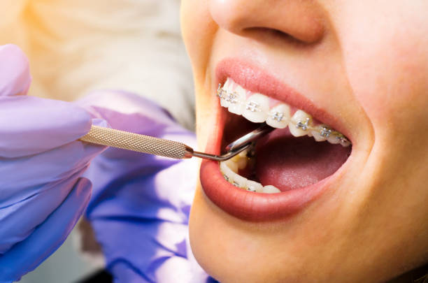 Straighten Your Smile with Confidence: A Complete Guide to Braces in Mableton - Newsglo