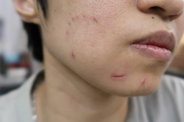 Can Facial Scar Revision Reduce Surgical Scars