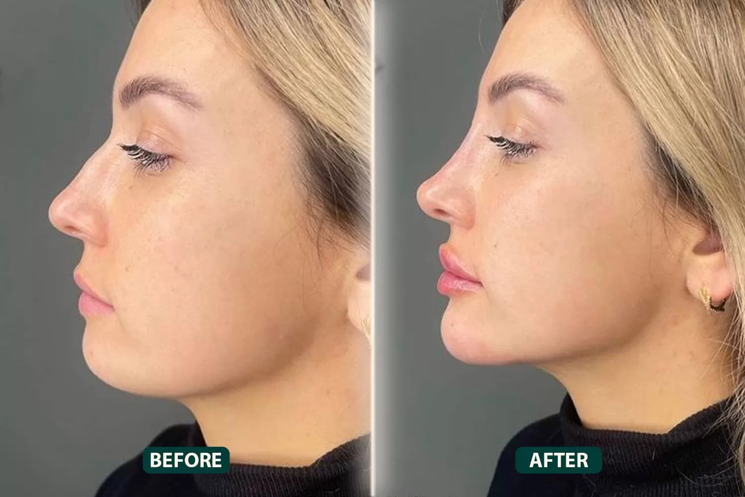 Augmentation Rhinoplasty: Building Up Your Nose Naturally - Newsglo Augmentation Rhinoplasty: Building Up Your Nose Naturally - Newsglo