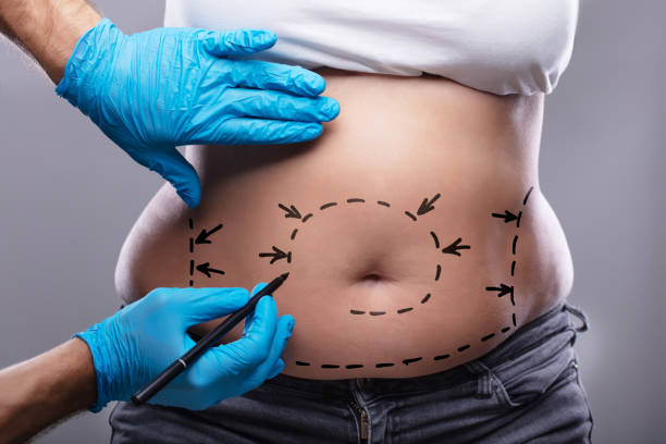Can Tummy Tuck Remove Stretch Marks