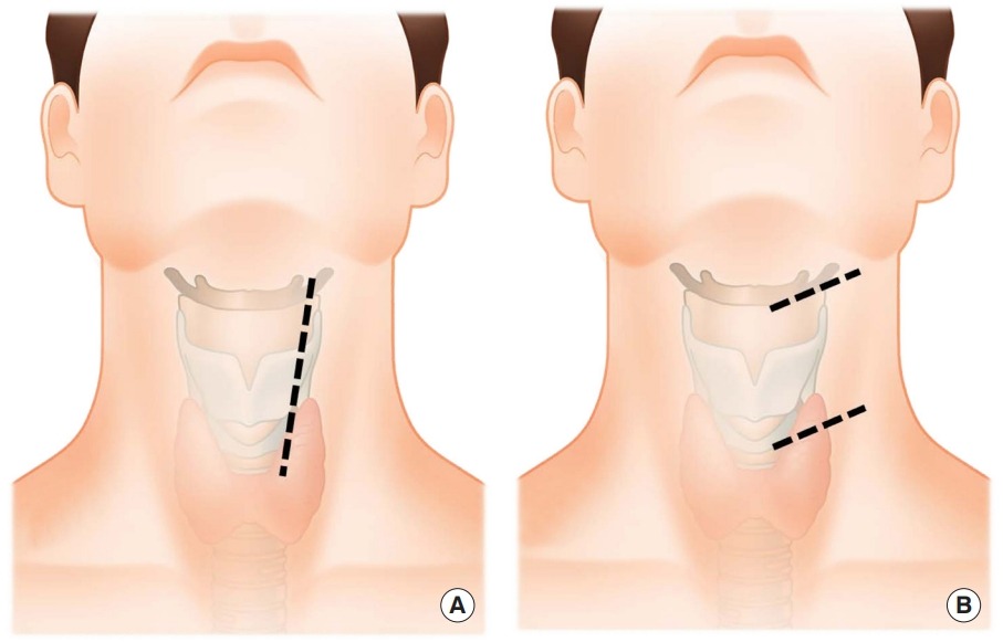 Cervical Fusion Scar