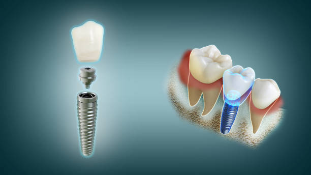 Restore Strength and Confidence with Advanced Dental Implants in Park Ridge - Newsglo