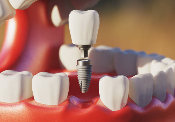 Do Dental Implants Look Natural