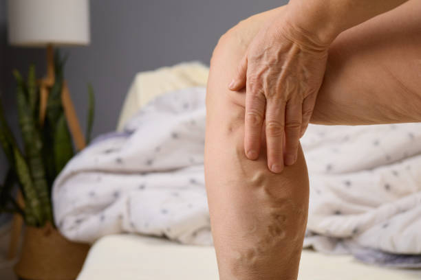 Does Varicose Veins Treatment Leave Scars? - Newsglo Does Varicose Veins Treatment Leave Scars