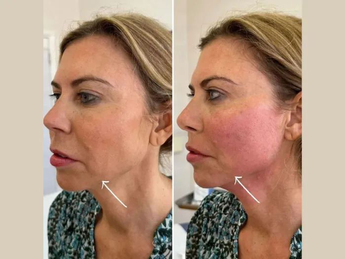 Endolift Treatment in Dubai for Youthful Skin Transformation
