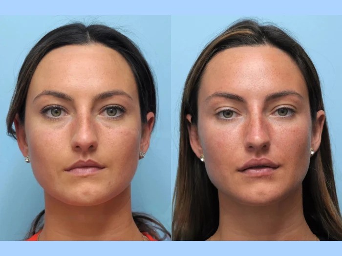 Best Plastic Surgeon in Dubai: Thread Lift Jawline Definition Experts