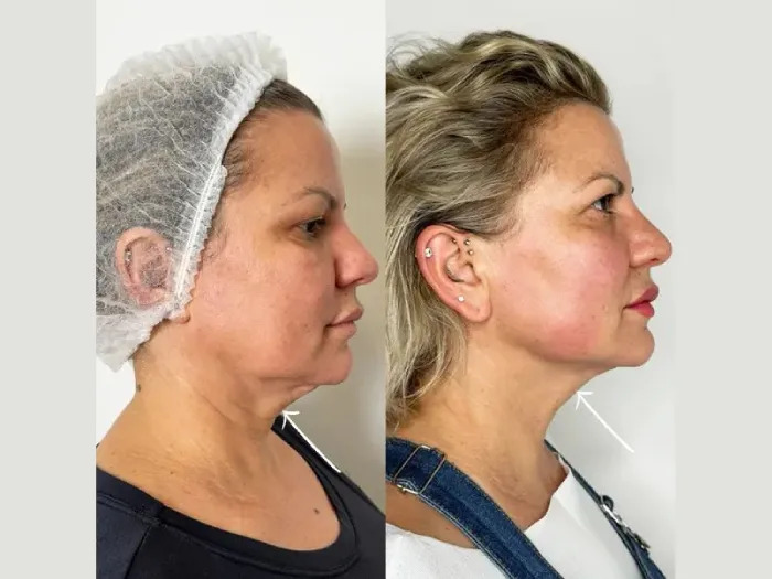 Endolift in Dubai for Double Chin and Fat Reduction