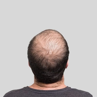 Hair transplant surgeon in islamabad