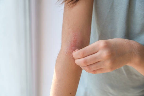 How Effective Is Eczema Treatment