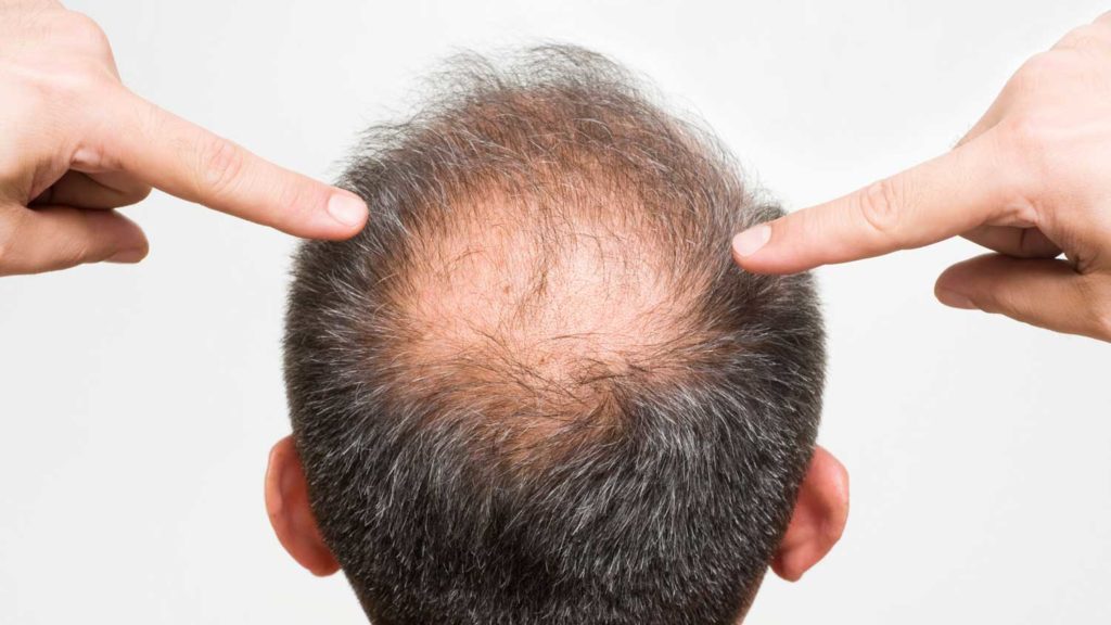 How Hair Loss Treatment Improves Density