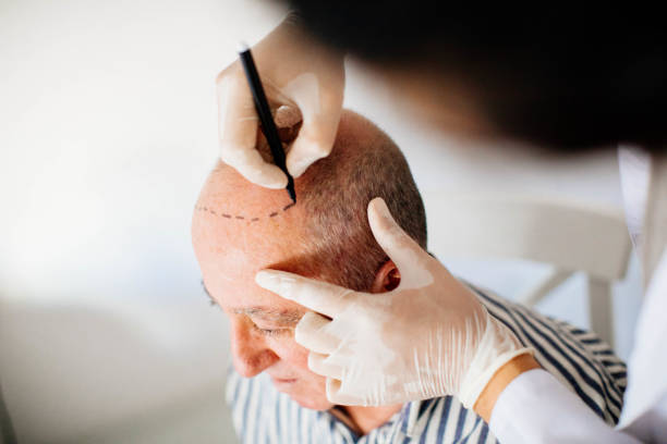 How Hair Transplant Works for Thinning Areas