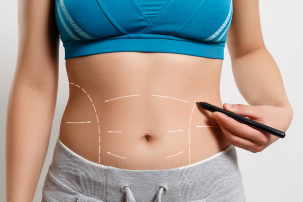 How Long Do Results From a Mini Tummy Tuck Last