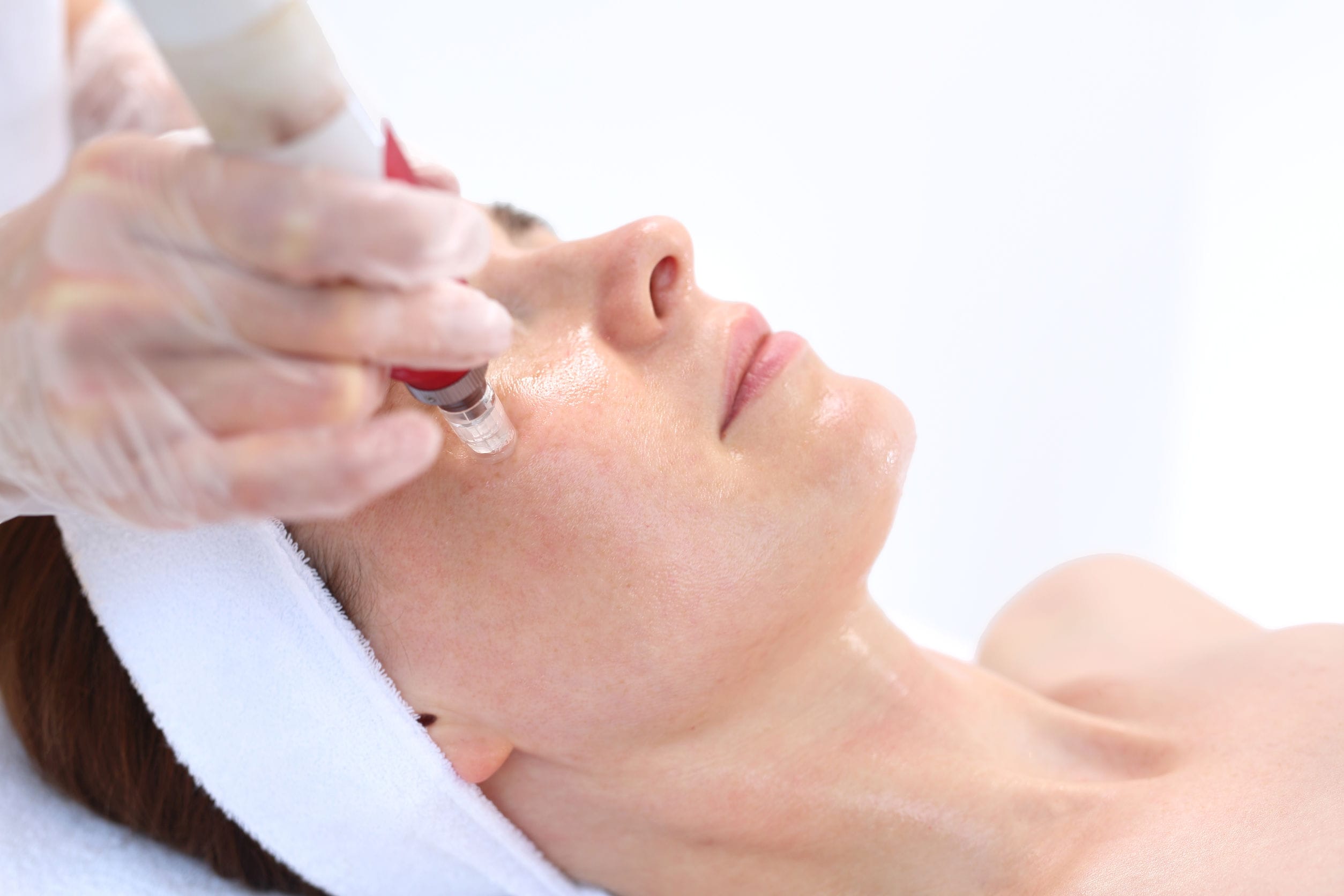 How Microneedling Differs From Regular Facials