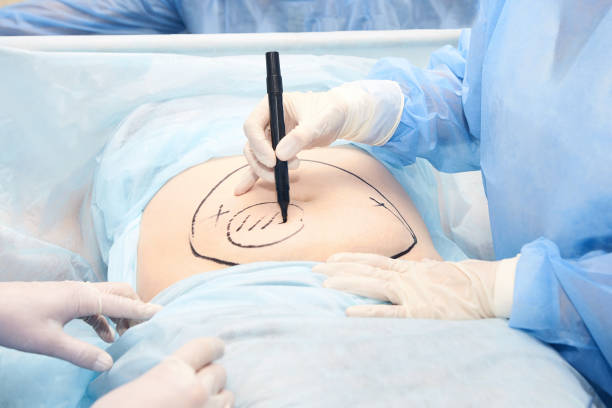 How Much Weight Can You Lose With Tummy Tuck Surgery?