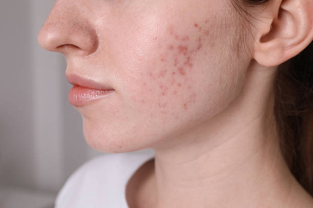 How Safe Is Laser Acne Scar treatment