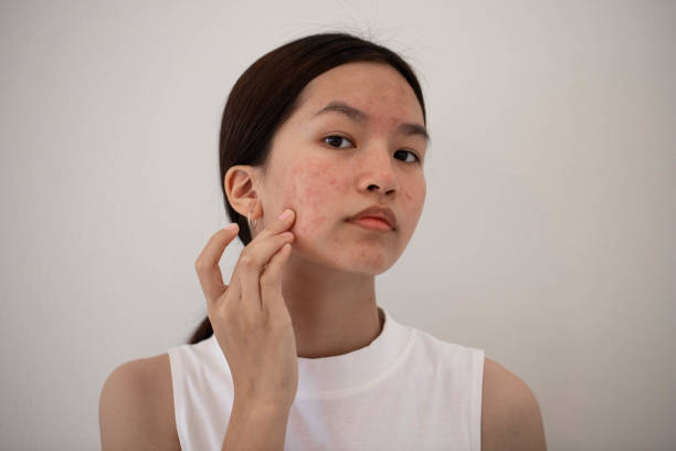 Is Acne Treatment Safe for Sensitive Skin? - Newsglo Is Acne Treatment Safe for Sensitive Skin?