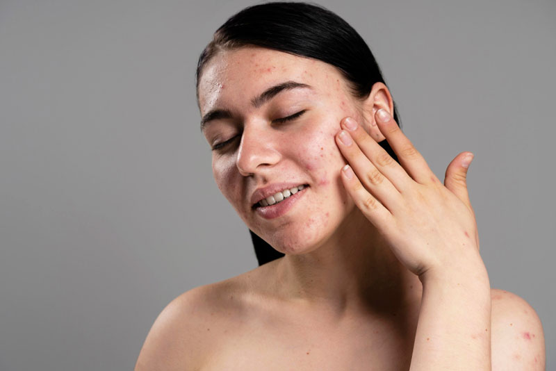 Is Acne Treatment Worth the Cost?