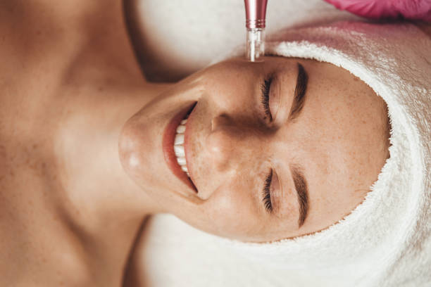 Is Dermapen Microneedling Safe for Acne