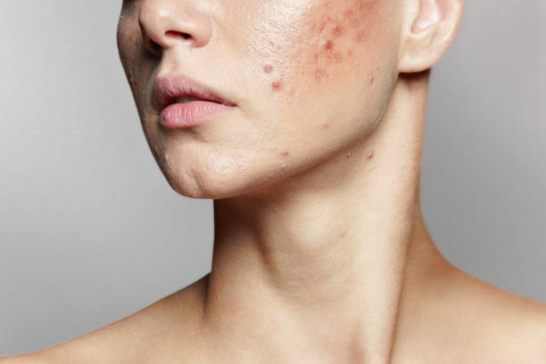 Is Laser Acne Scar treatment effective for deep scars