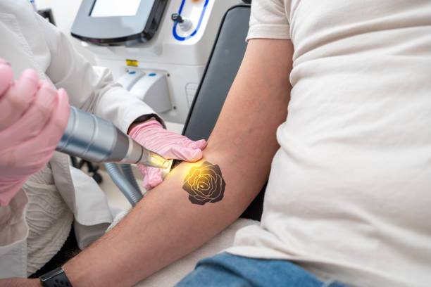 Is Laser Tattoo Removal Safe for All Skin