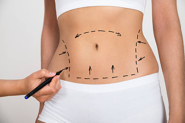 Is Lipo abdominoplasty Right for You