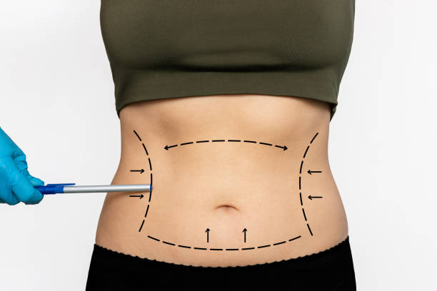 Is Liposuction Safe for Stubborn Fat