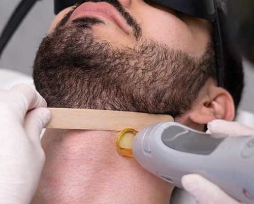 Is beard laser hair removal risk free