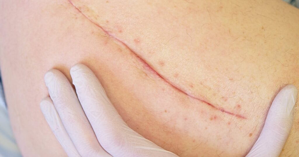 Which Treatments Work Best for Surgical Scars?