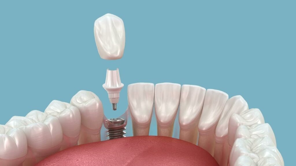 Single Tooth Implant in Cantonment FL for Natural Looking Results