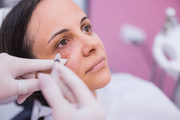 What Are the Benefits of Under Eye Fillers?