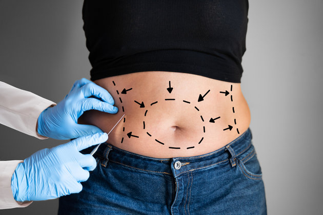 What Results Can You Expect from Liposuction Surgery