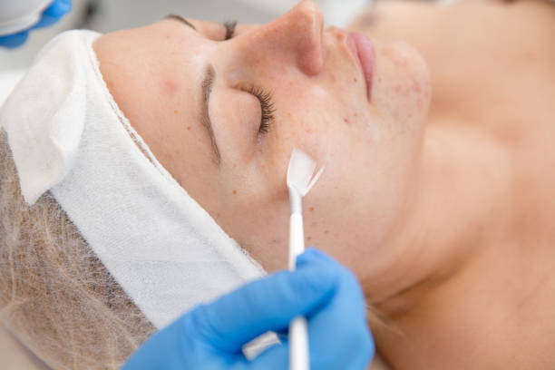 What Skin Types Benefit From Chemical Peel