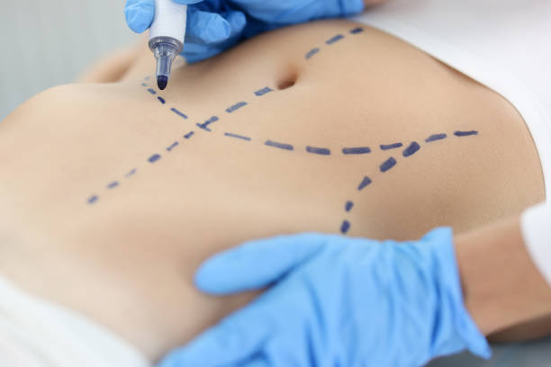 What is Liposuction and How Does it Work?
