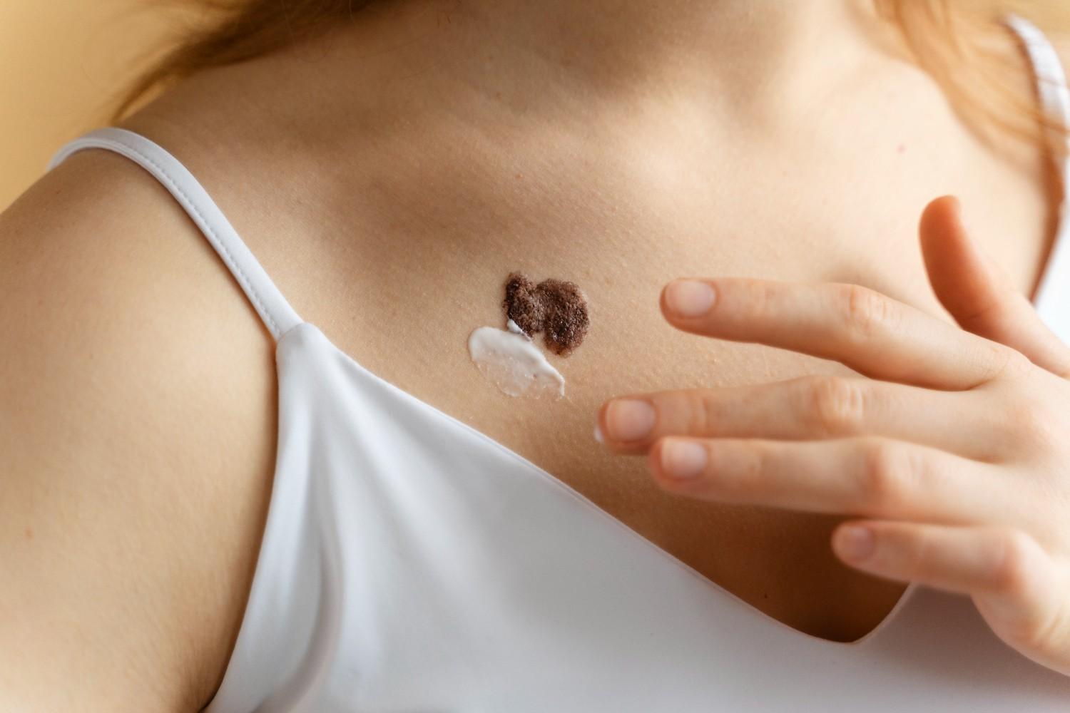 What to Expect After Mole Removal Treatment