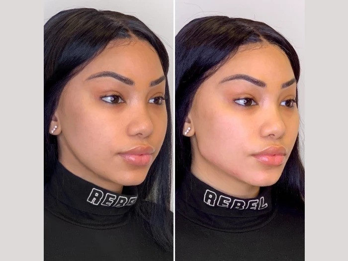 Best Plastic Surgeons in Dubai Provides Professional Thread Lift Care