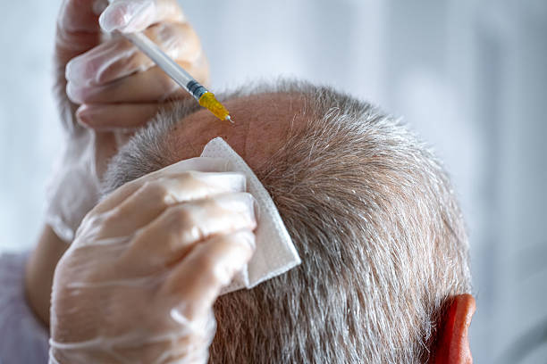 Who Is a Good Candidate for Stem Cell Hair Transplant ? - Newsglo Who Is a Good Candidate for Stem Cell Hair Transplant