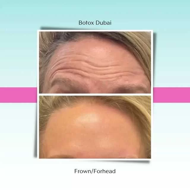 Botox in Dubai