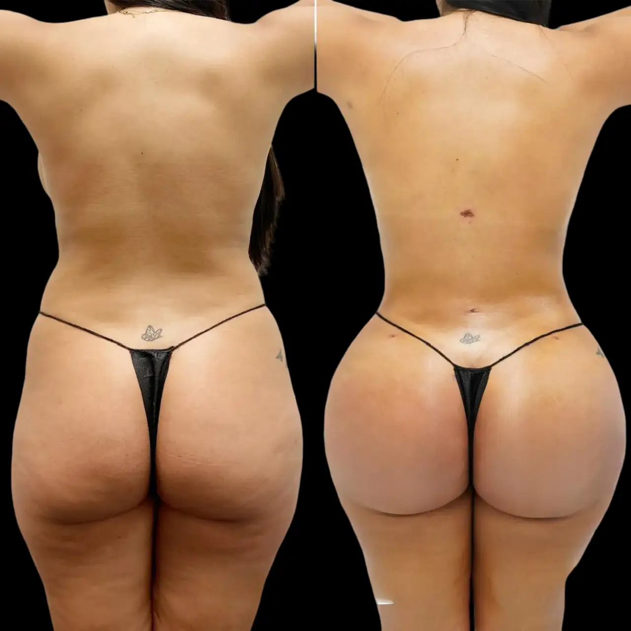 Butt Fat transfer in dubai