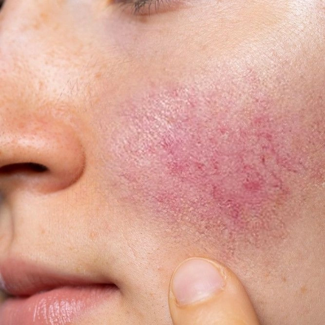 Is It Possible to Permanently Cure Rosacea?