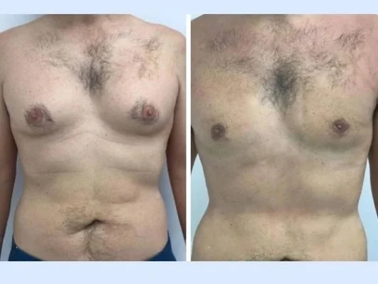 Gynecomastia Surgery in Dubai: How to Maintain Results Through Fitness and Nutrition - Newsglo gynecomastia in dubai
