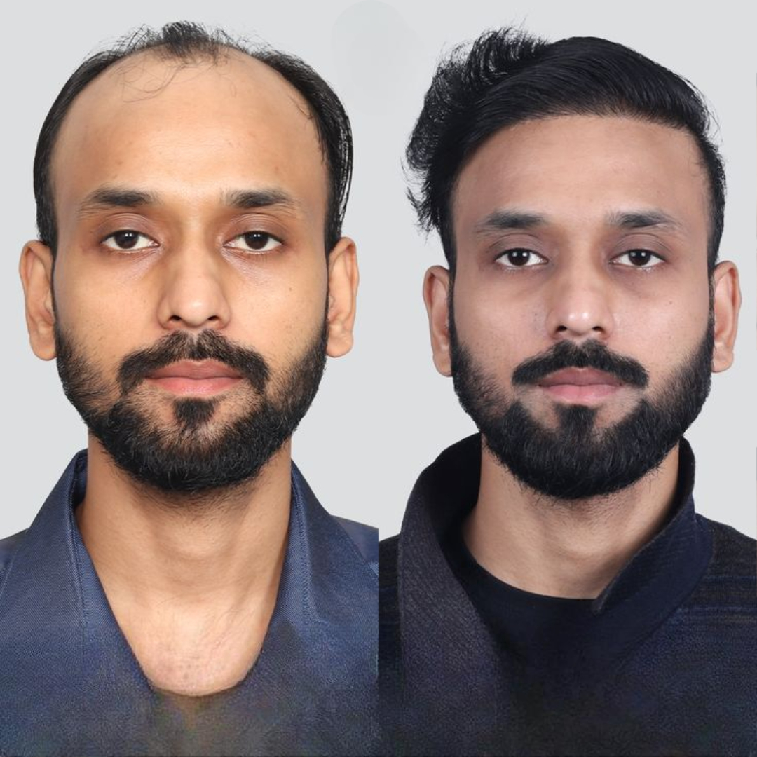 hair transplant